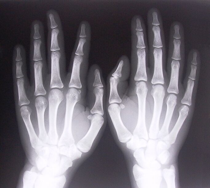 La radiographie comme moyen de diagnostiquer la douleur dans les articulations des doigts